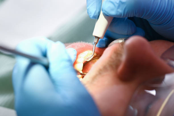 Best Emergency Dental Care for Abscessed Tooth in St Clair Shores, MI